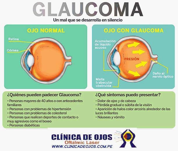 TRATAMIENTO MODERNO PARA... - Clínica de Ojos Oftalmic Laser | Facebook