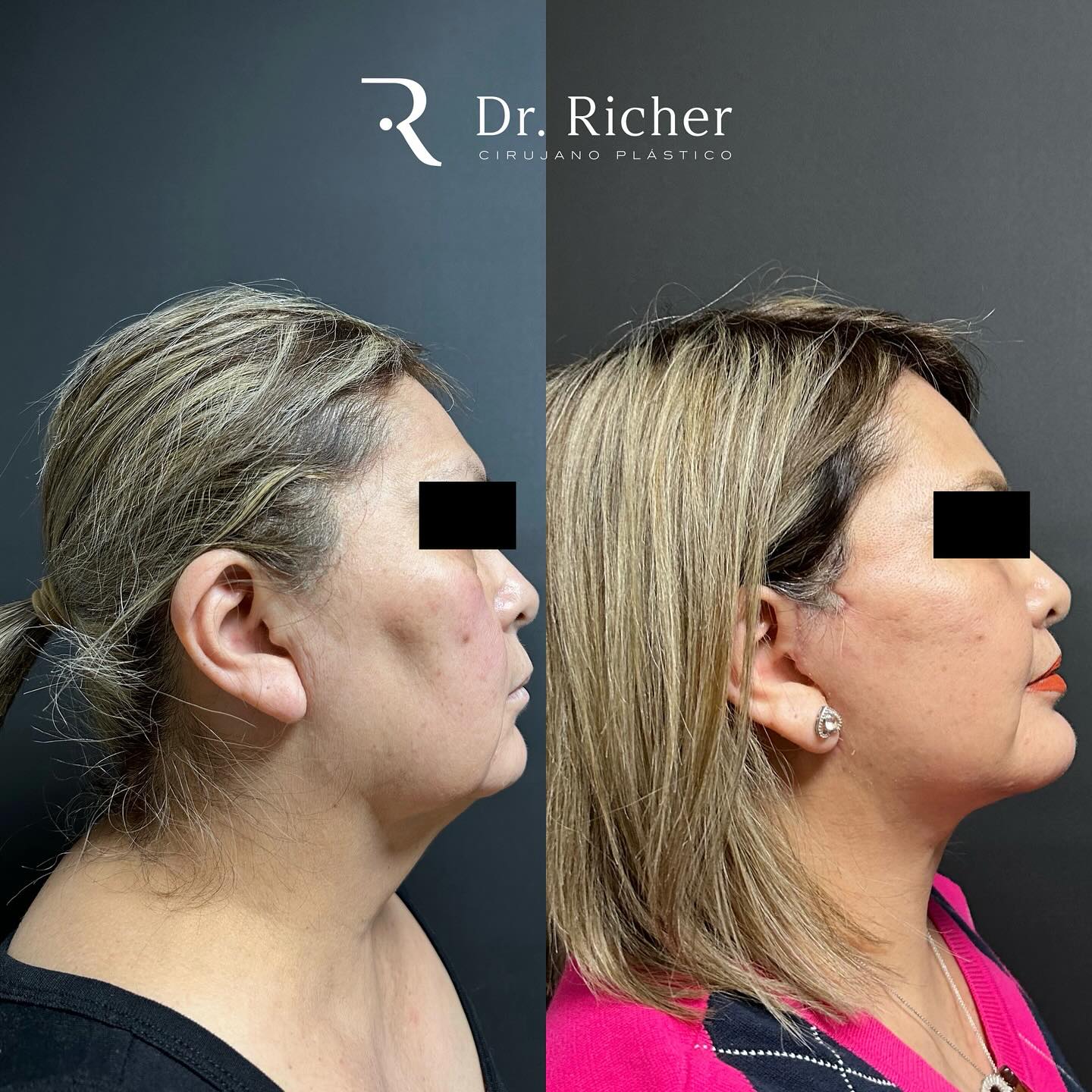 Resultado de mi paciente a... - Dr. Richer Cirujano Plástico | Facebook