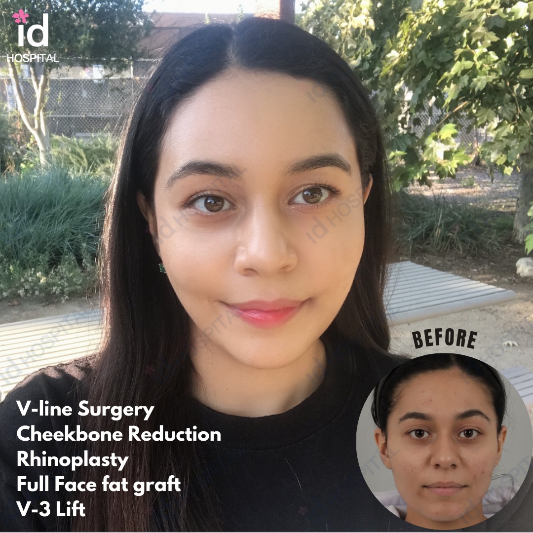 Nardeen came to ID... - ID Plastic Surgery Hospital Korea | Facebook