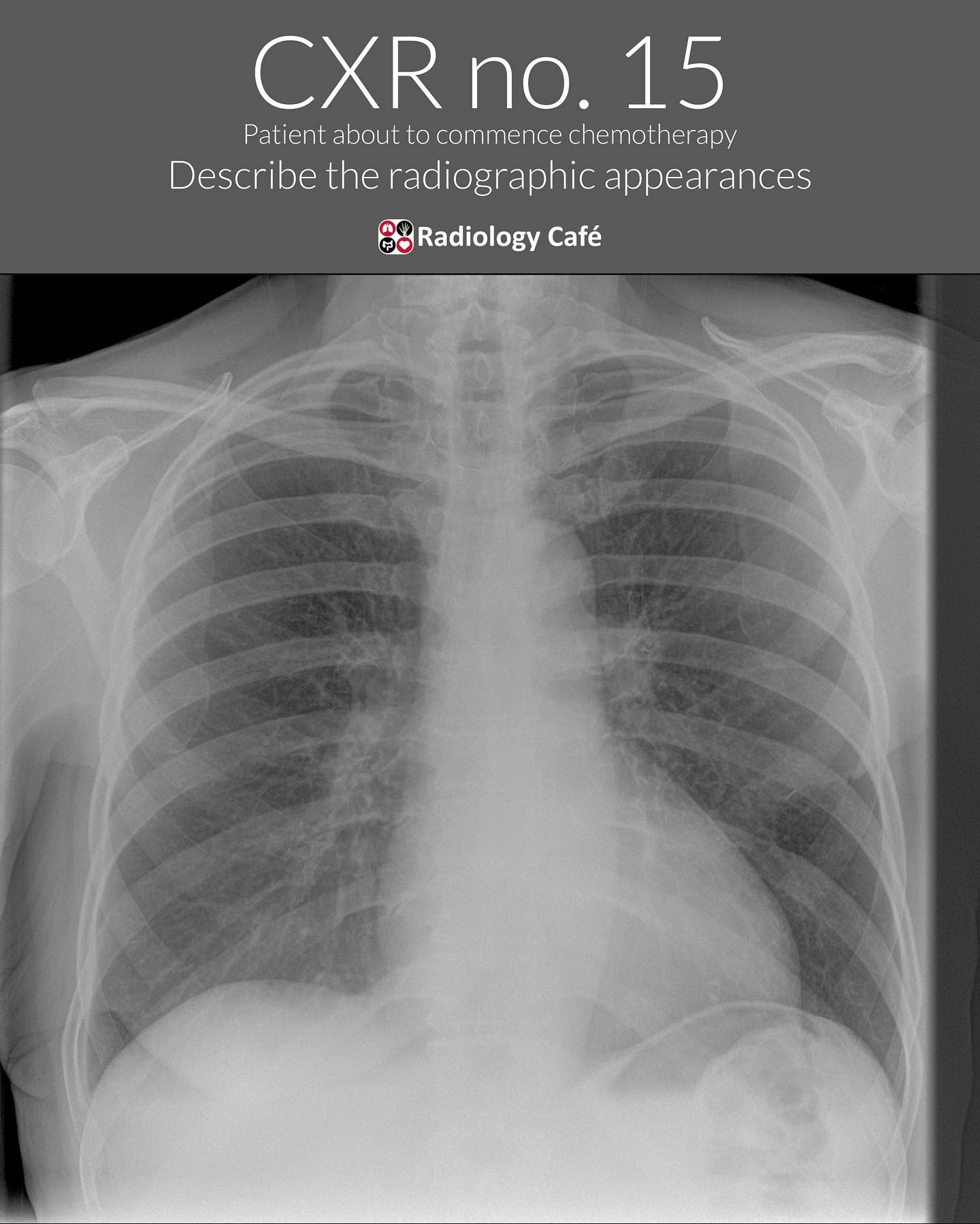 Radiology Cafe - CXR No. 15 Answer: Malpositioned right...