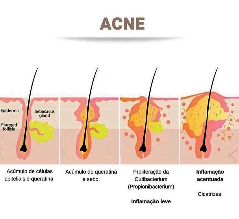 Propionibacterium Acnes