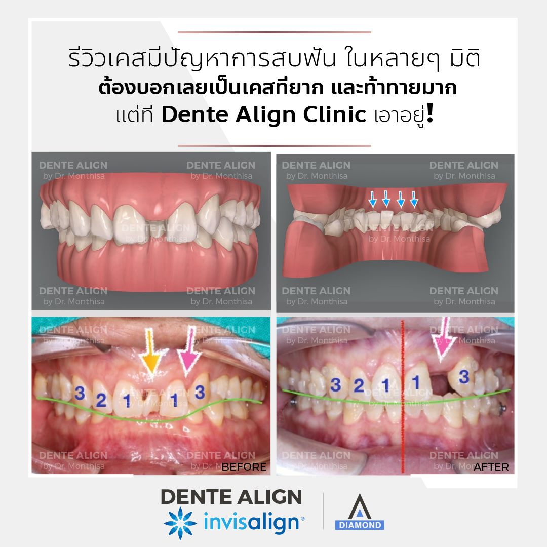 รีวิวเคส... - Dente Align Clinic - Invisalign Diamond Provider