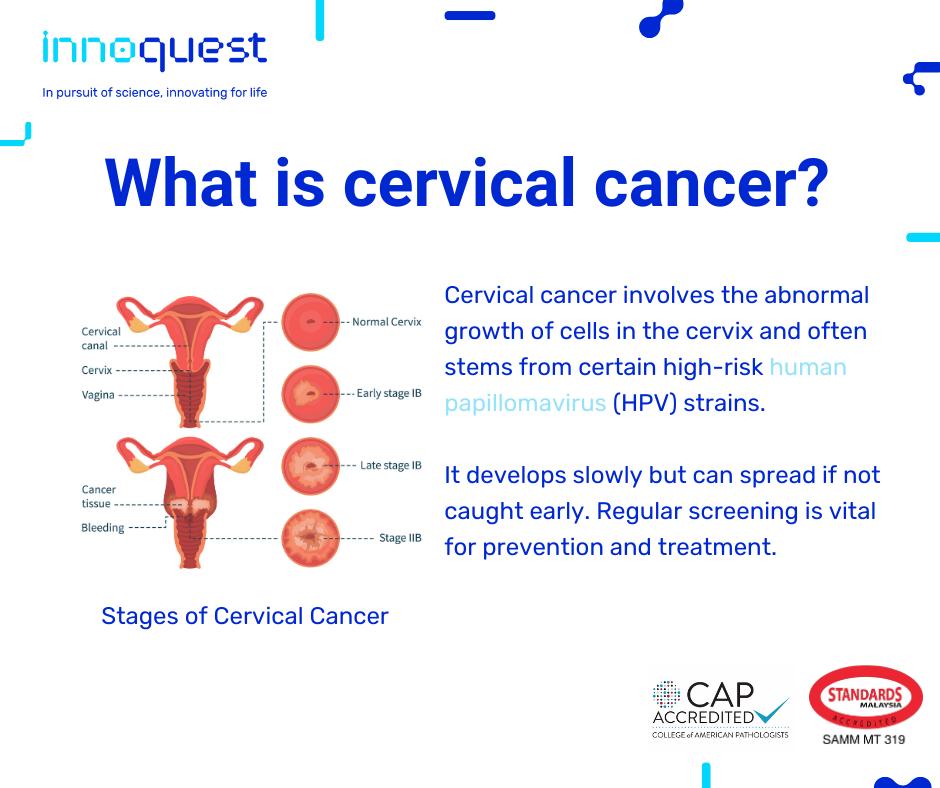 Cervical cancer silently ranks as the... - Innoquest Malaysia
