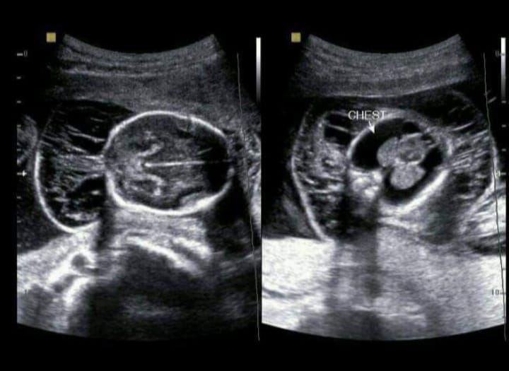 The Medivan - Hydrops fetalis is a serious fetal condition... | Facebook