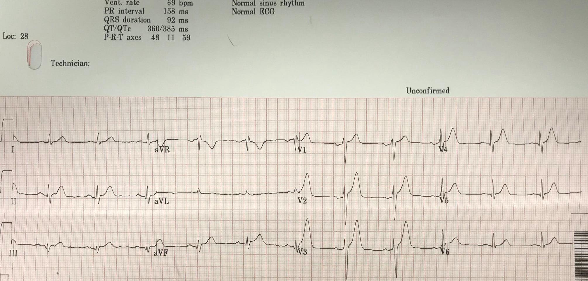 Let's Use Aslanger's simplified... - Dr. Smith's ECG Blog