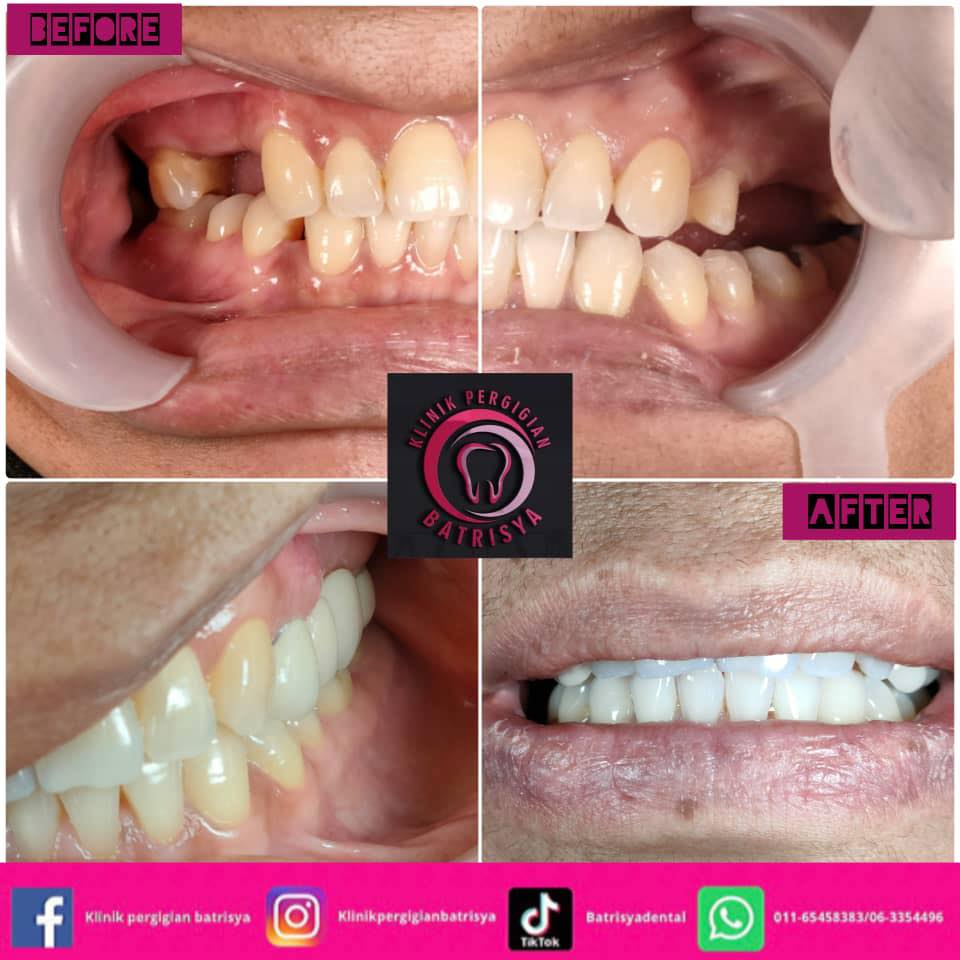Dental bridge (jambatan gigi)... - Klinik Pergigian Batrisya | Facebook