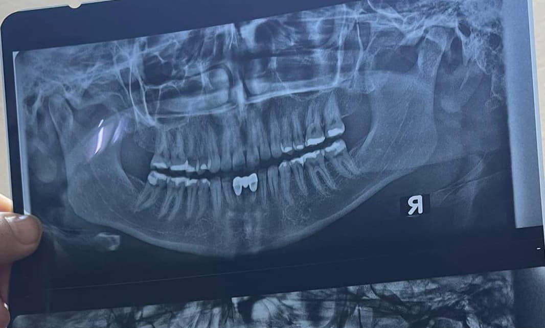 Oral health تەندروستی دەم و ددان | Malmö