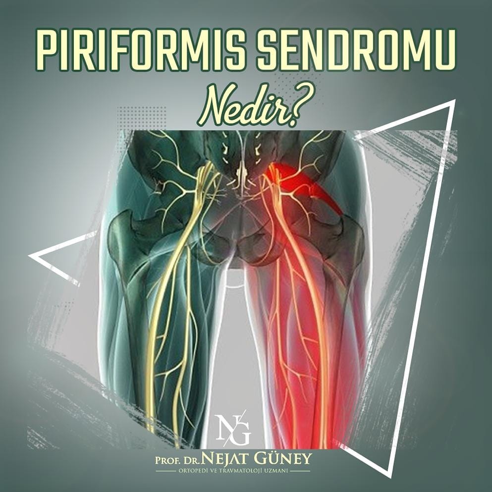 Prof.Dr.Nejat Güney - Piriformis kasının, yakınındaki siyatik sinire ...