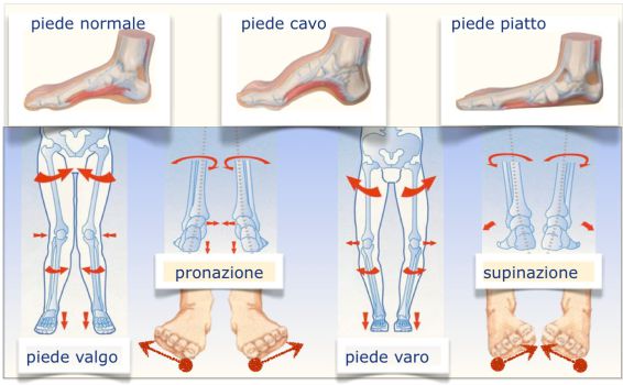 studio-podologia-dott-luca-deflorio-fascite-plantare-la-fascite