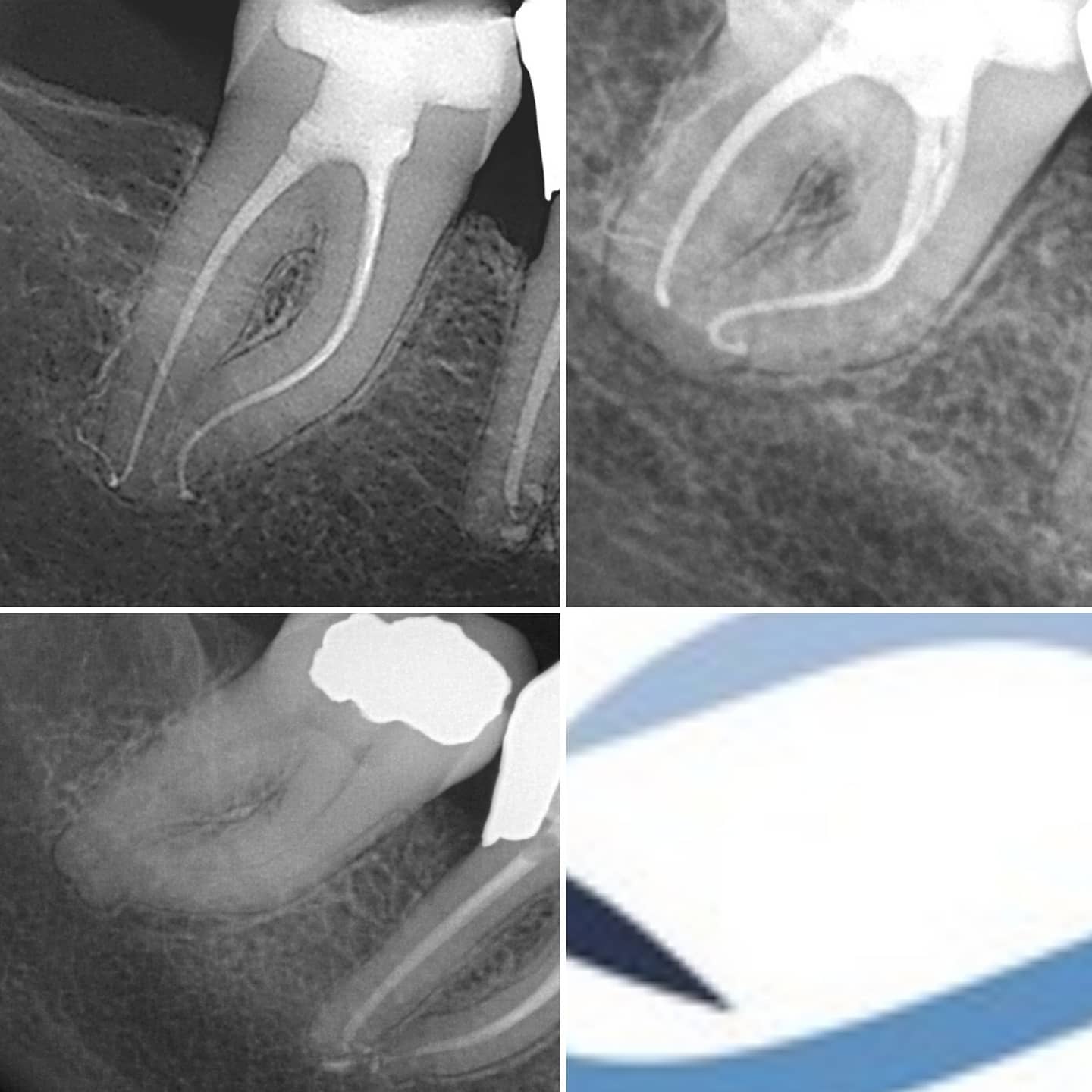 Tidy RCT. Interesting to see difference in the anatomy in the off angle ...