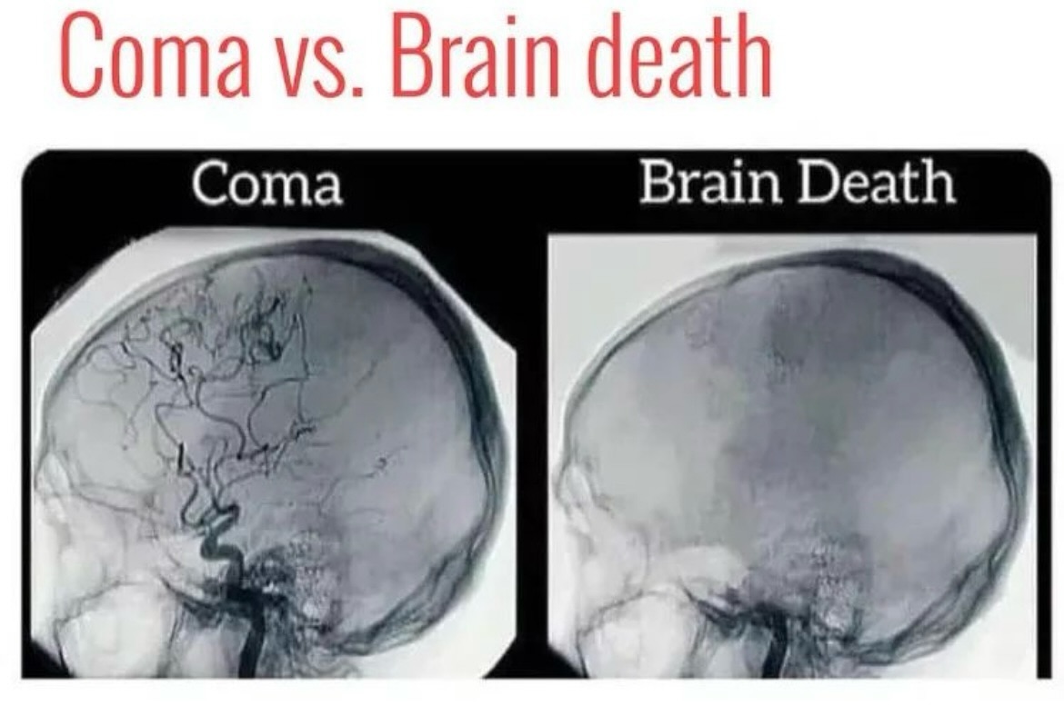 Dr. Joe, MD - 🧠 Understanding Coma vs. Brain Death 🧠 This...