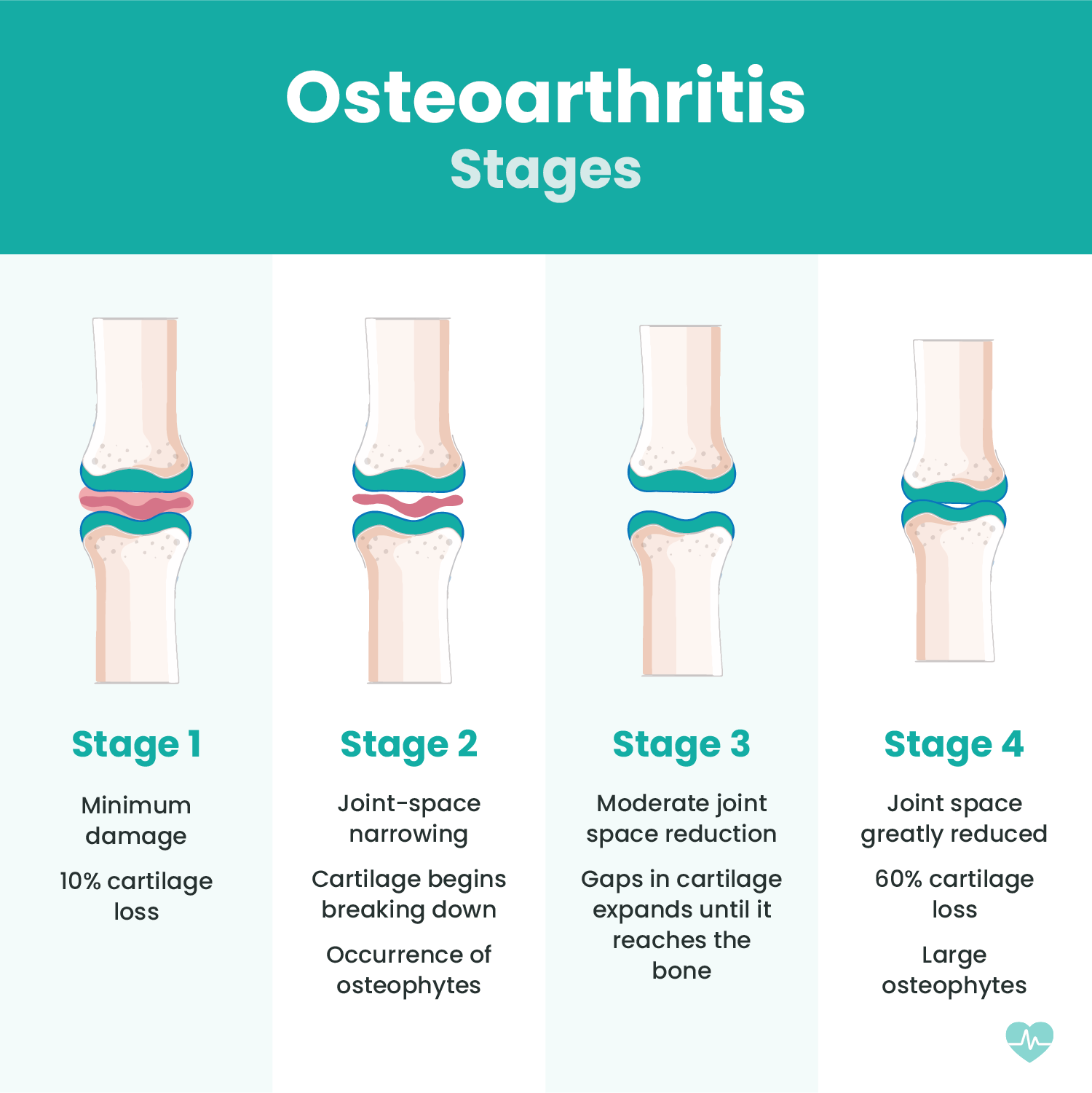 MediMagic - What are the stages of knee osteoarthritis? 🦴...