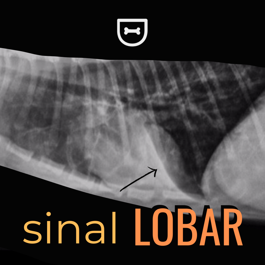 UniRadio - ☢Chamamos de sinal lobar o achado radiográfico...