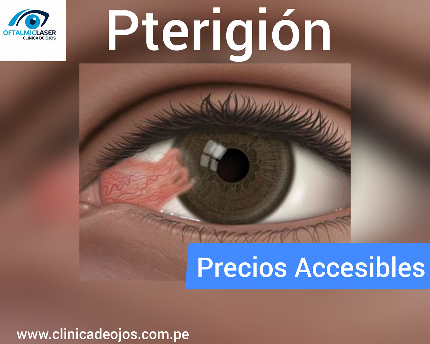 👩‍⚕️CIRUGÍA MODERNA DE... - Clínica de Ojos Oftalmic Laser