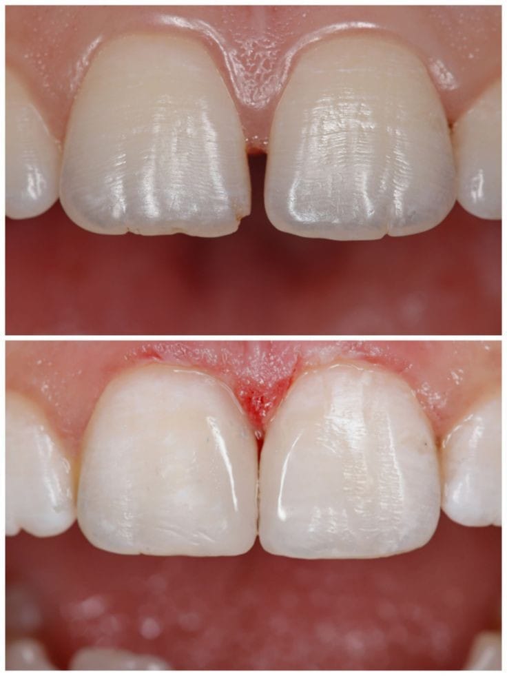 What is a diastema and how to close it