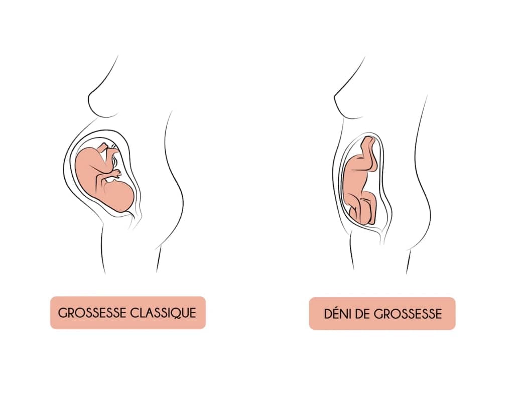 Rever De Faire Un Deni De Grossesse