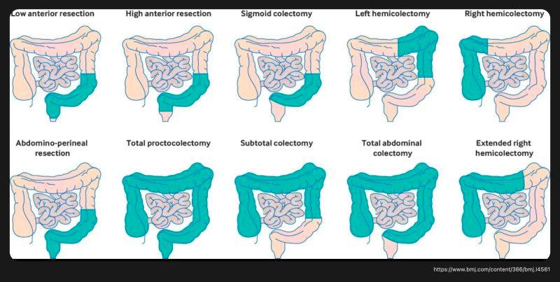 EndoCollab - Types of Colectomies: ↓ - Low anterior... | Facebook
