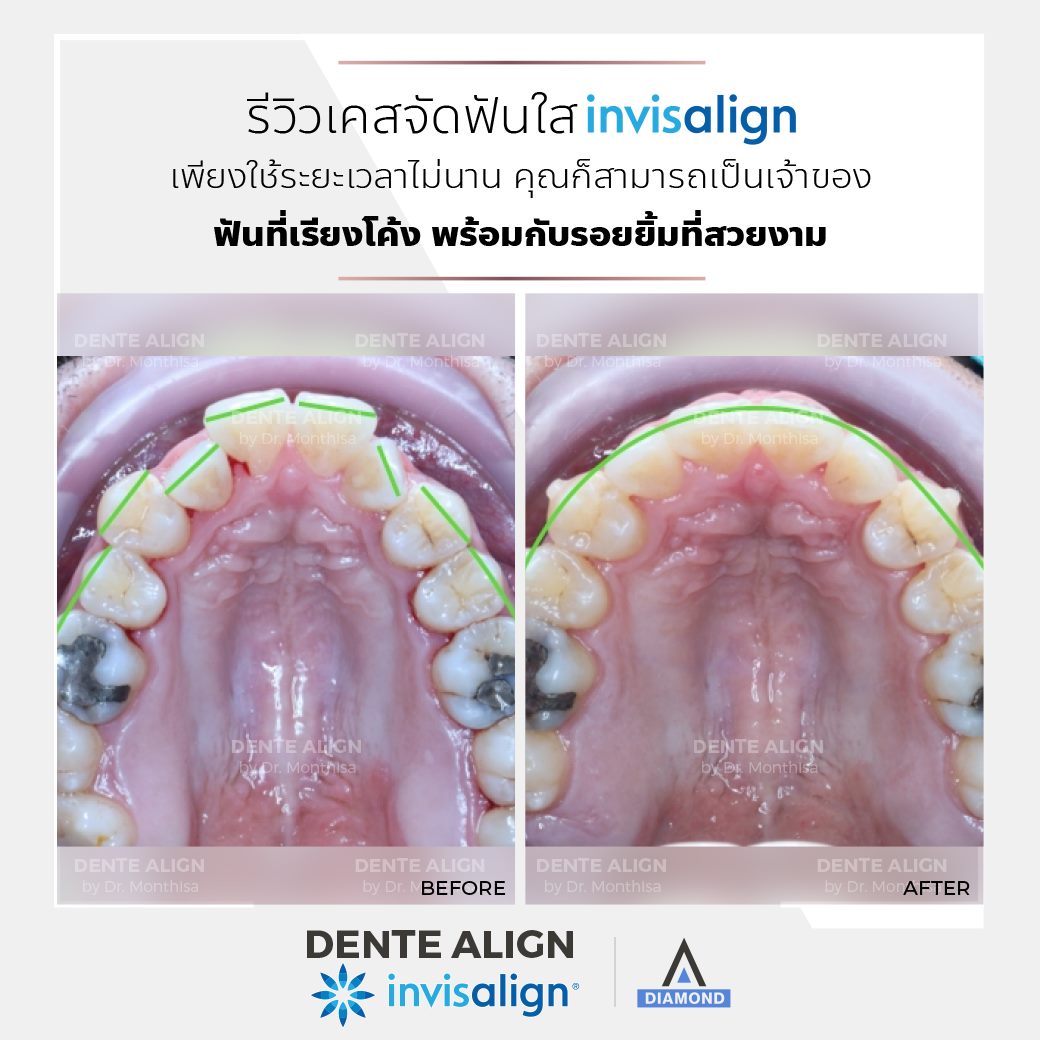 รีวิวเคส... - Dente Align Clinic - Invisalign Diamond Provider | Facebook