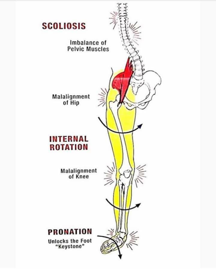 FIT 80 - ESCOLIOSIS Y RODILLA. El genu valgo es una deformidad ...