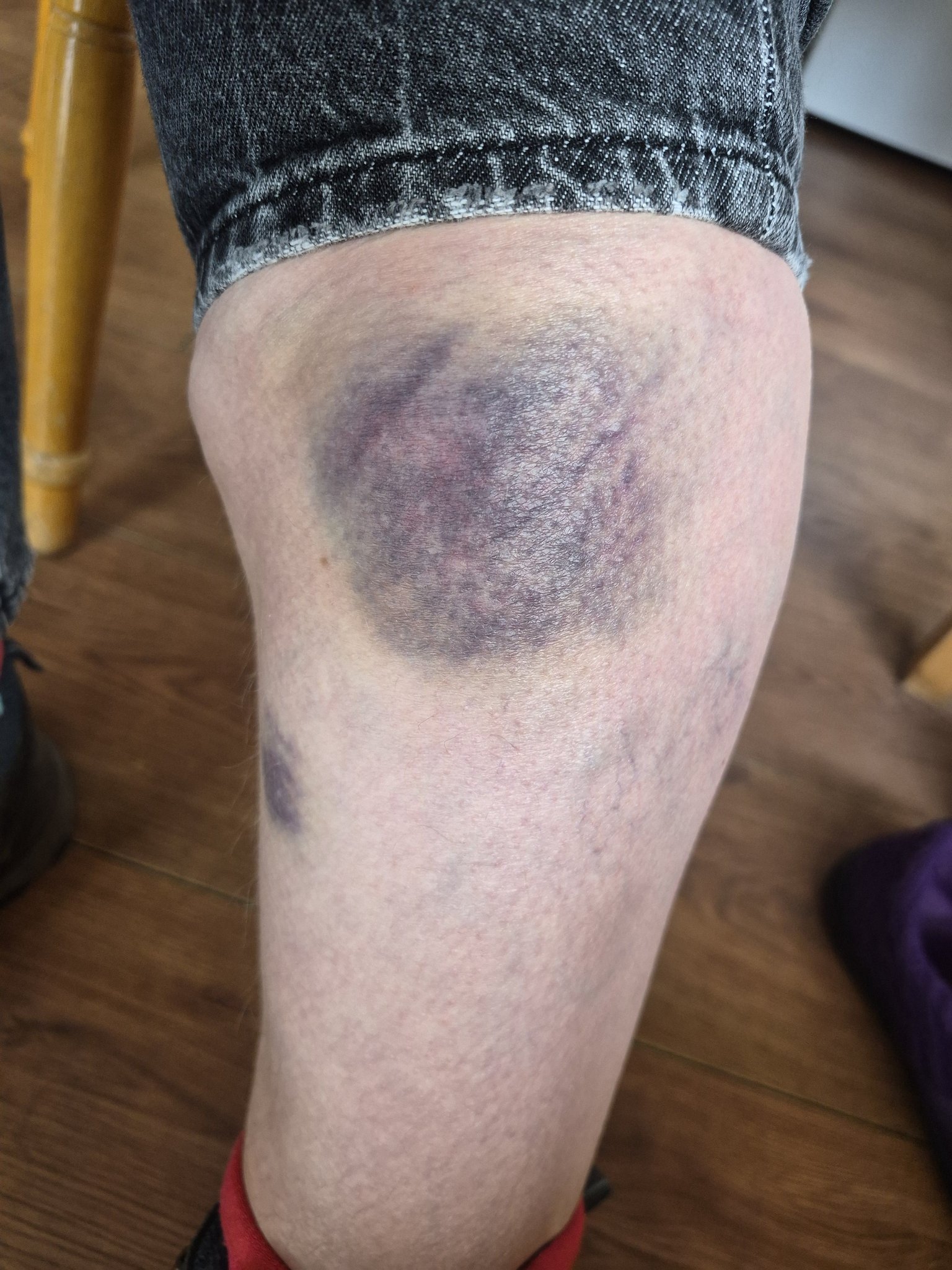 bruising glp 1 Prevent After GLP-1 Injections – PlexusDx bruising from glp 1 injection