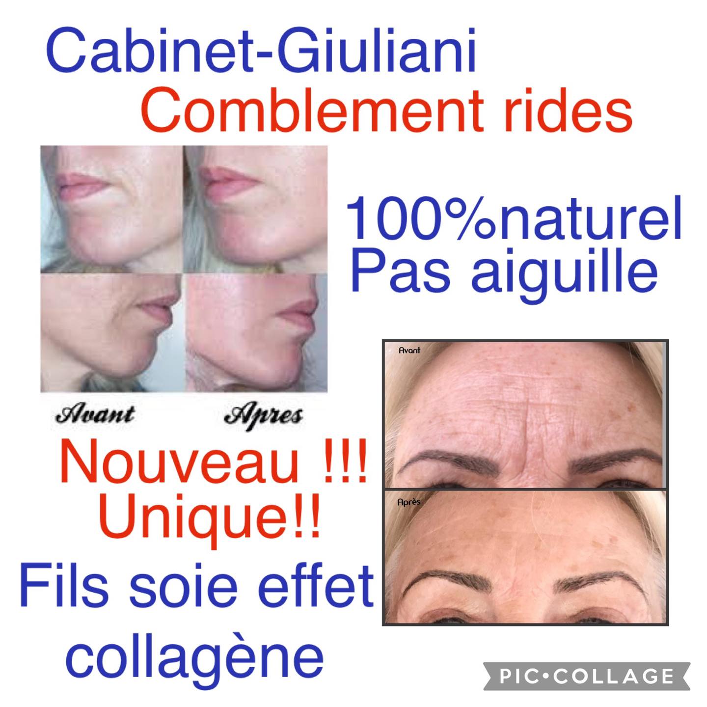 Fils De Soie Collagène Avant Après