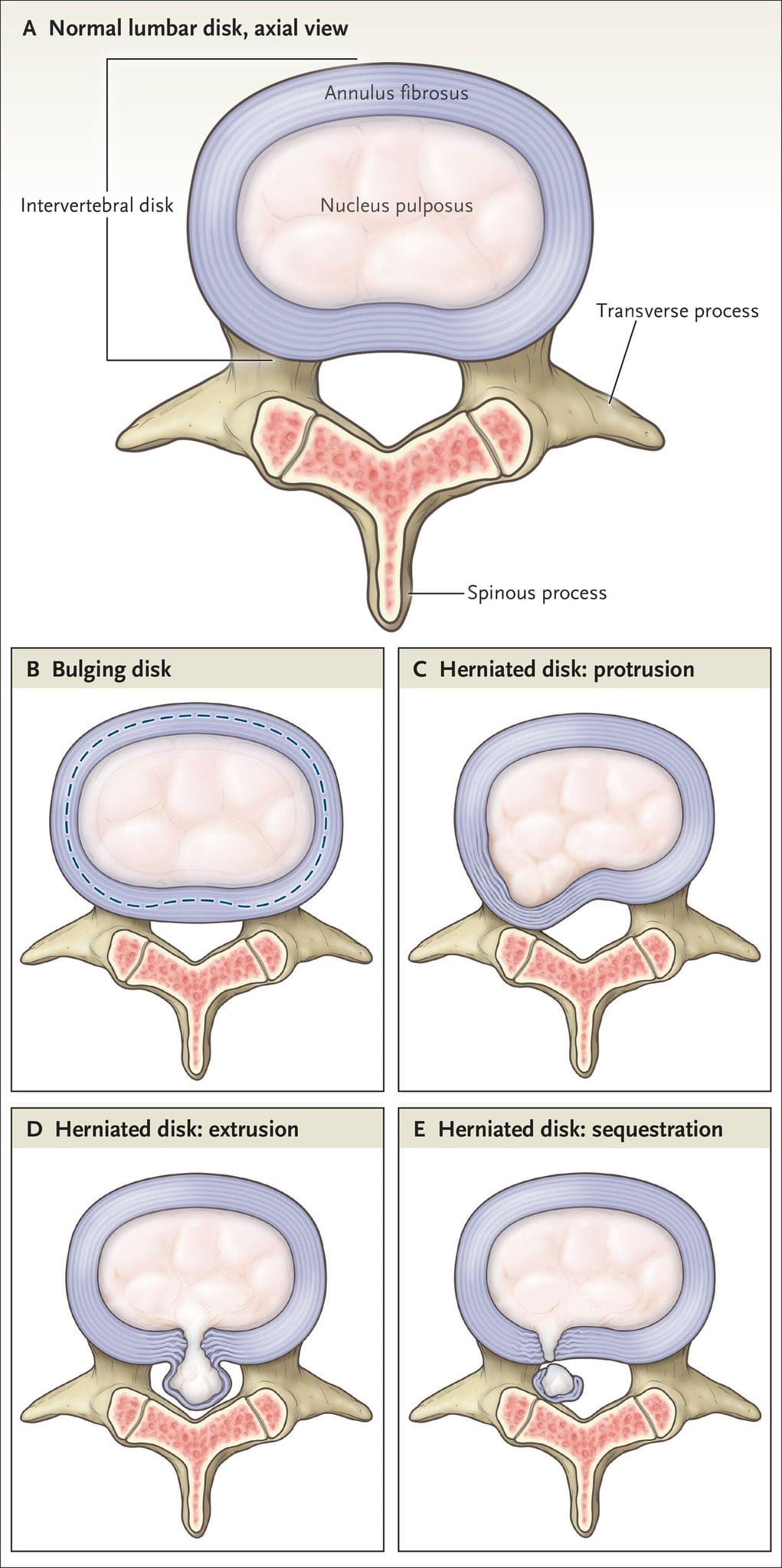 Human Anatomy Group | Herniated disc primer | Facebook