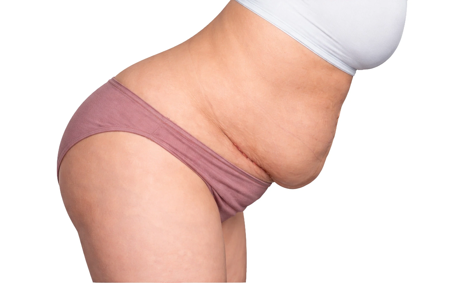 lipo c section shelf What is a C-section and how to reduce lower belly pouch? high-protein-snack