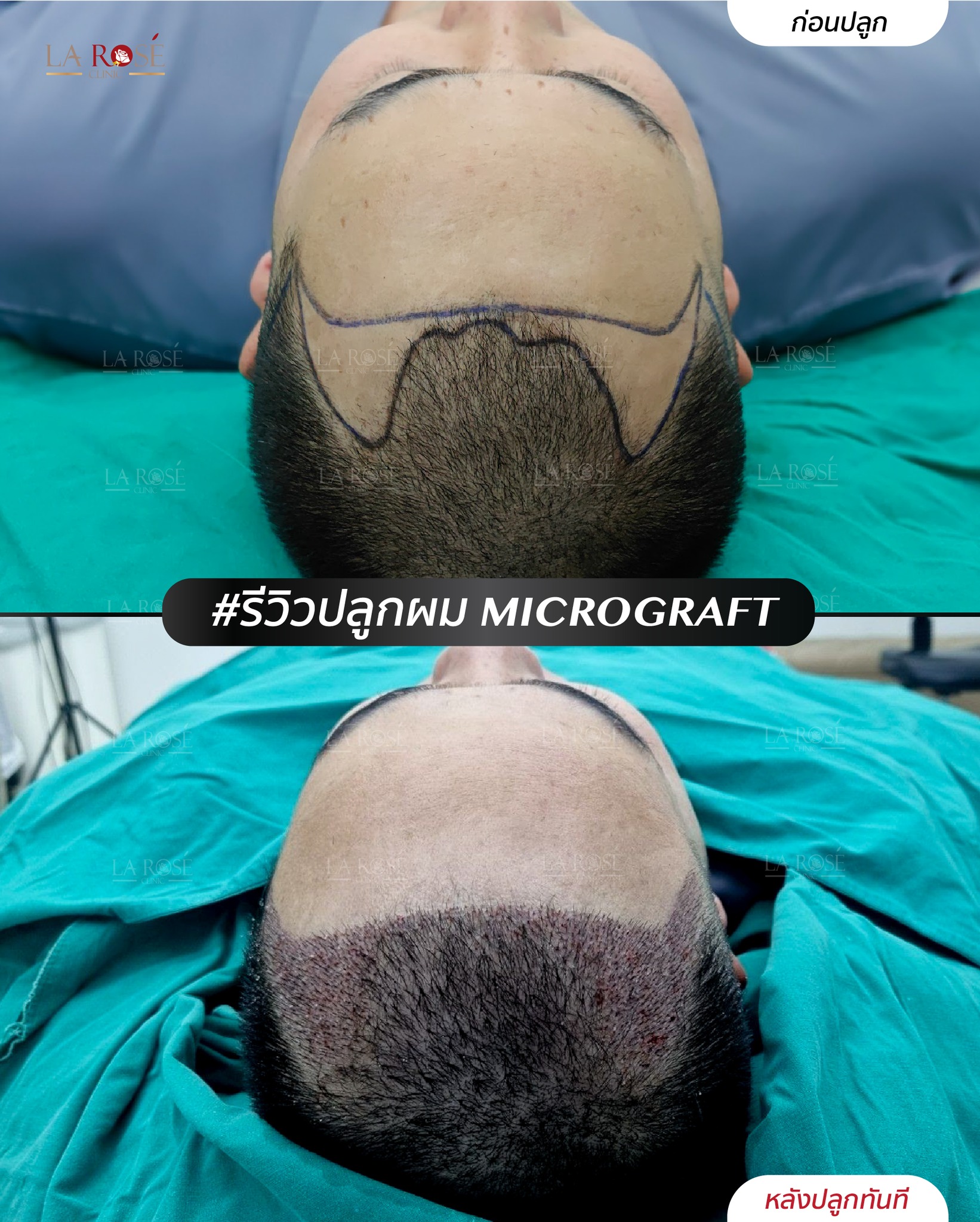 ‼... - Larose Clinic Hair Center ปลูกผมถาวร FUE Micrograft DHI