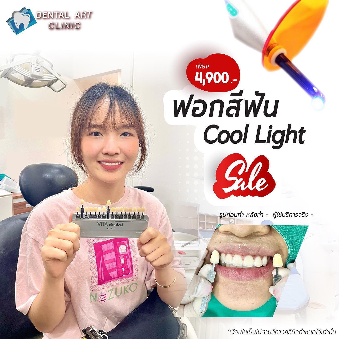 รีวิวค่า 😊 การฟอกสีฟันด้วยแสงเย็น Cool Light เป็นการใช้แสง LED ฉายลงบน ...