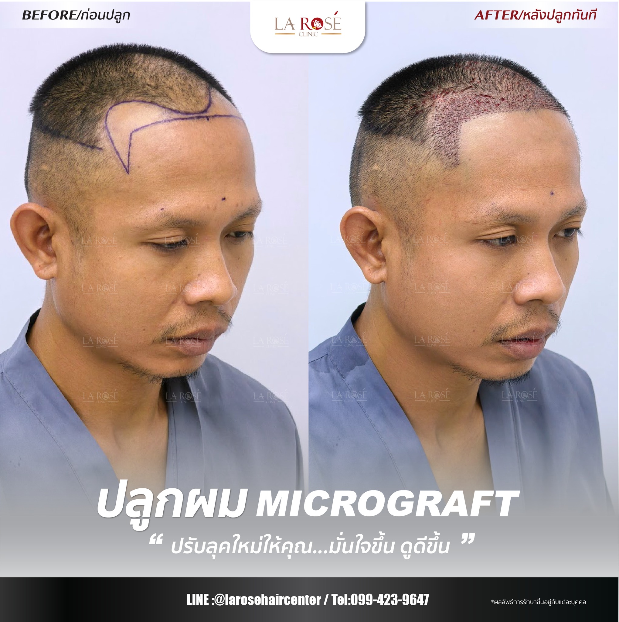 อ... - Larose Clinic Hair Center ปลูกผมถาวร FUE Micrograft DHI