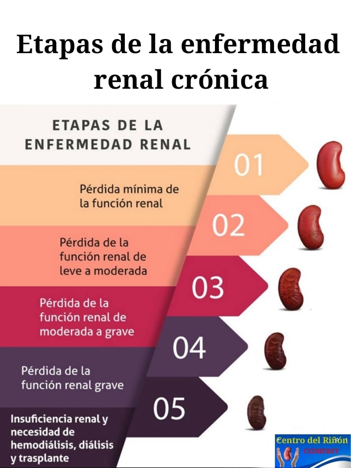 La enfermedad renal crónica (ERC) se... - Centro del Riñón