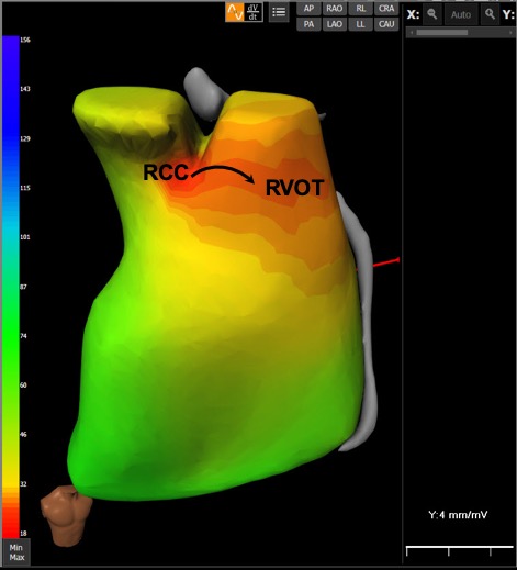 ECG-Imaging ECG-I activation... - Cardiac Rhythm Disorders