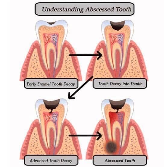 What is an abscessed tooth? An... - Metropolitan Endodontics | Facebook