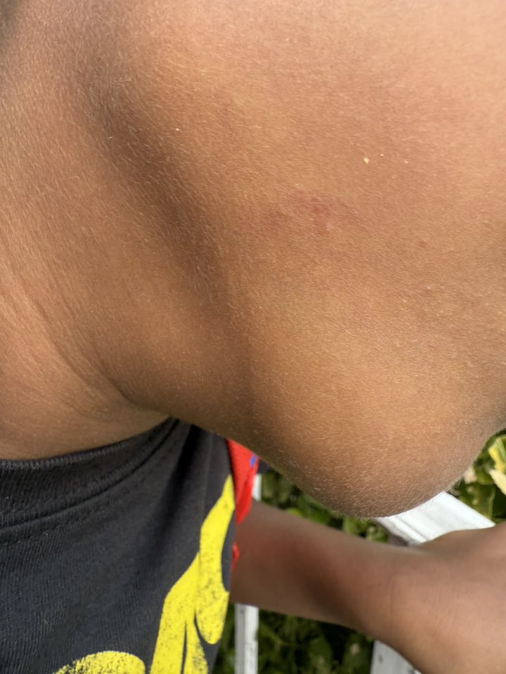 What happened to my non-verbal son's bruise at school?