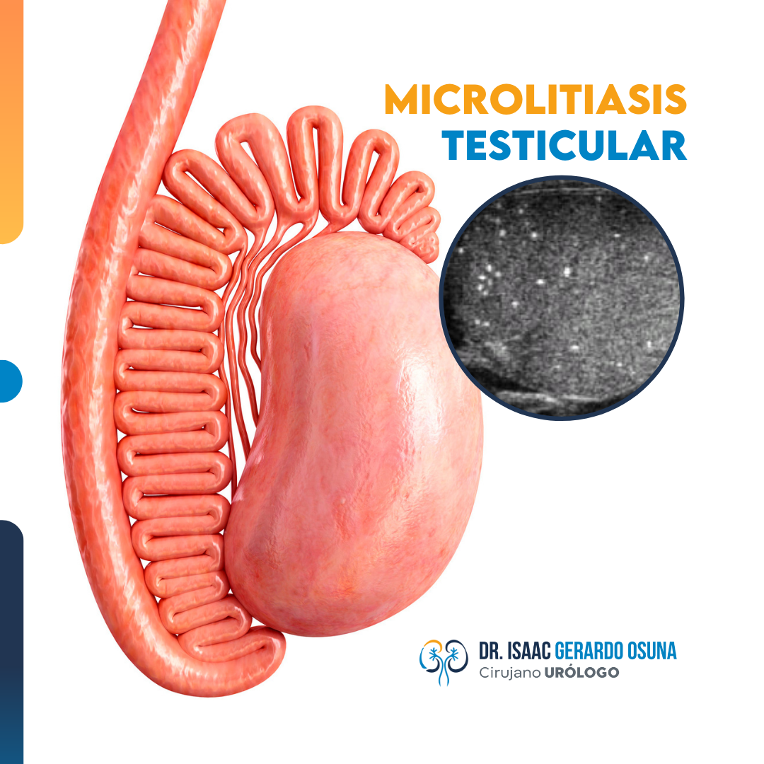 La #microlitiasis #testicular es... - Urologo Isaac Gerardo