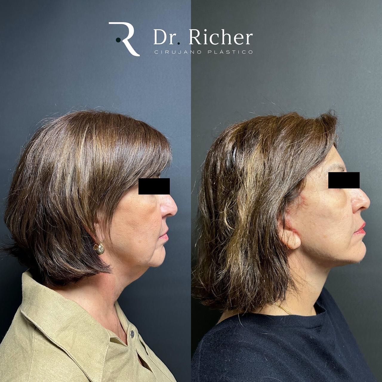 Resultado de mi paciente a... - Dr. Richer Cirujano Plástico | Facebook