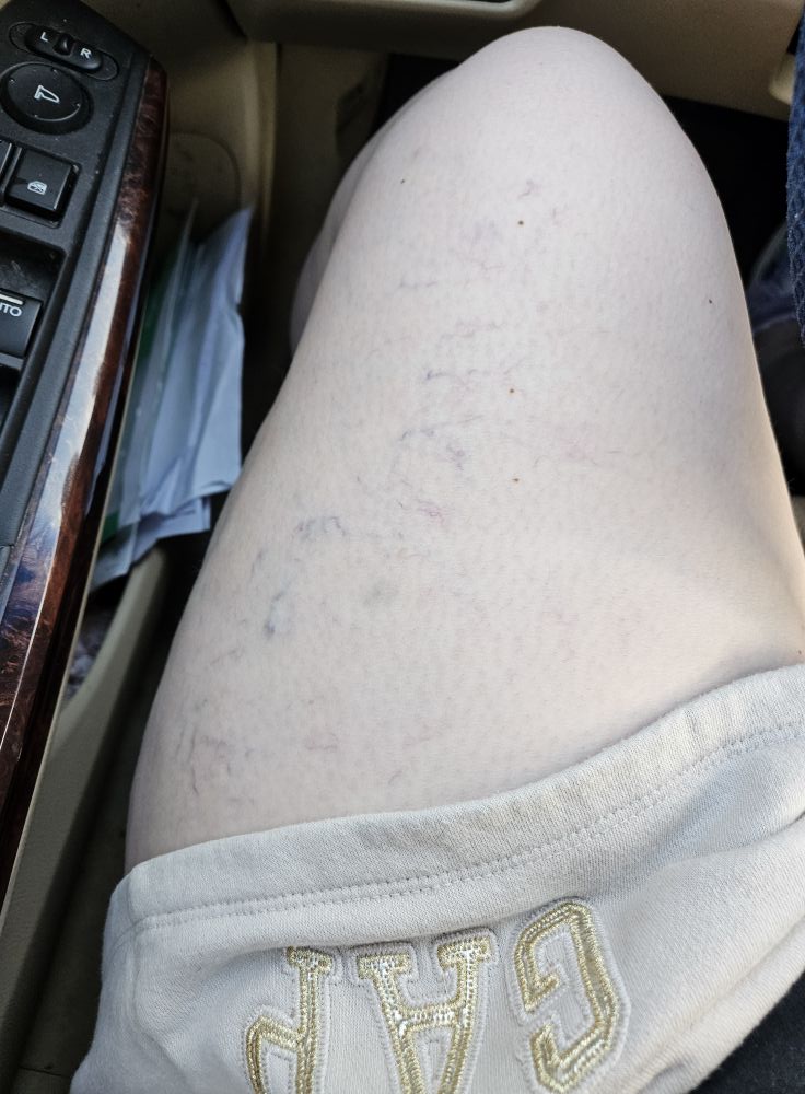 glp 1 and varicose veins Can Cause Foot Pain? Symptoms Relief Varicose veins - Symptoms and
