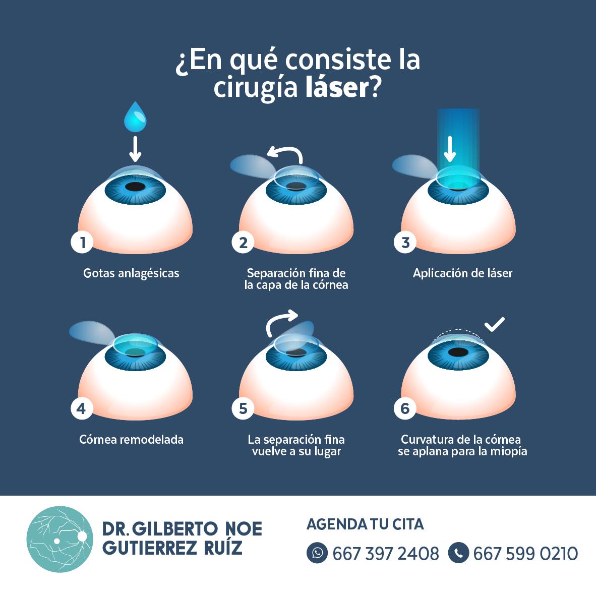 La cirugía láser es una de las operaciones más seguras y efectivas para ...