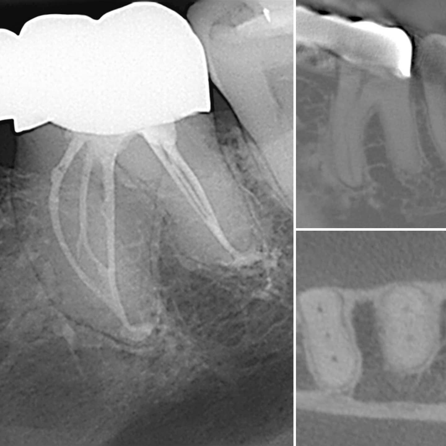Lower molar with 6 canals. Luckily we don't see too many of these. # ...