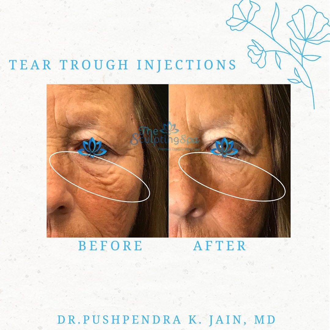 👀 TEAR TROUGH INJECTIONS 👀 This... - The Sculpting Spa