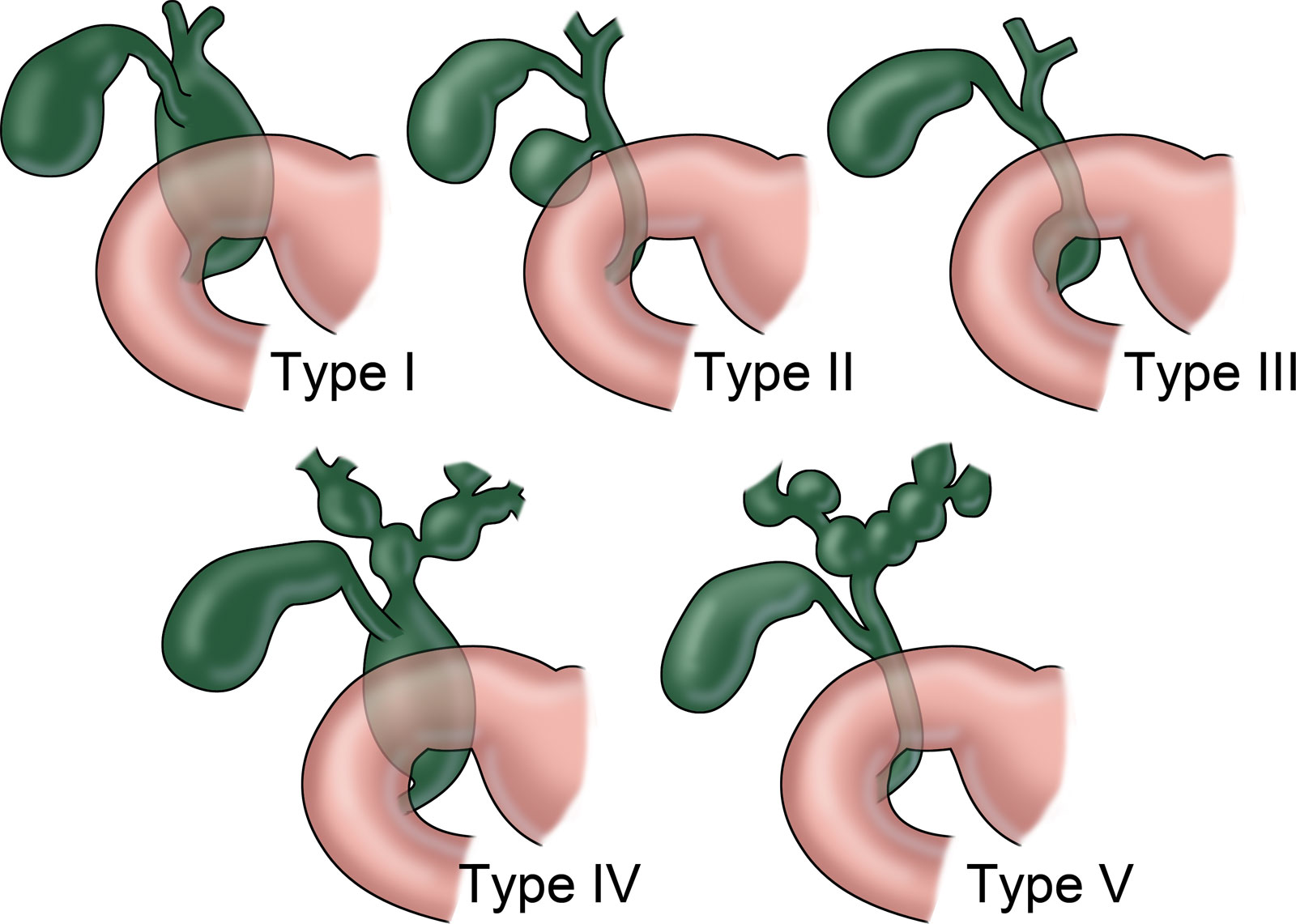 Choledochal Cyst & Anomalous Pancreatobiliary Junction - APBJ