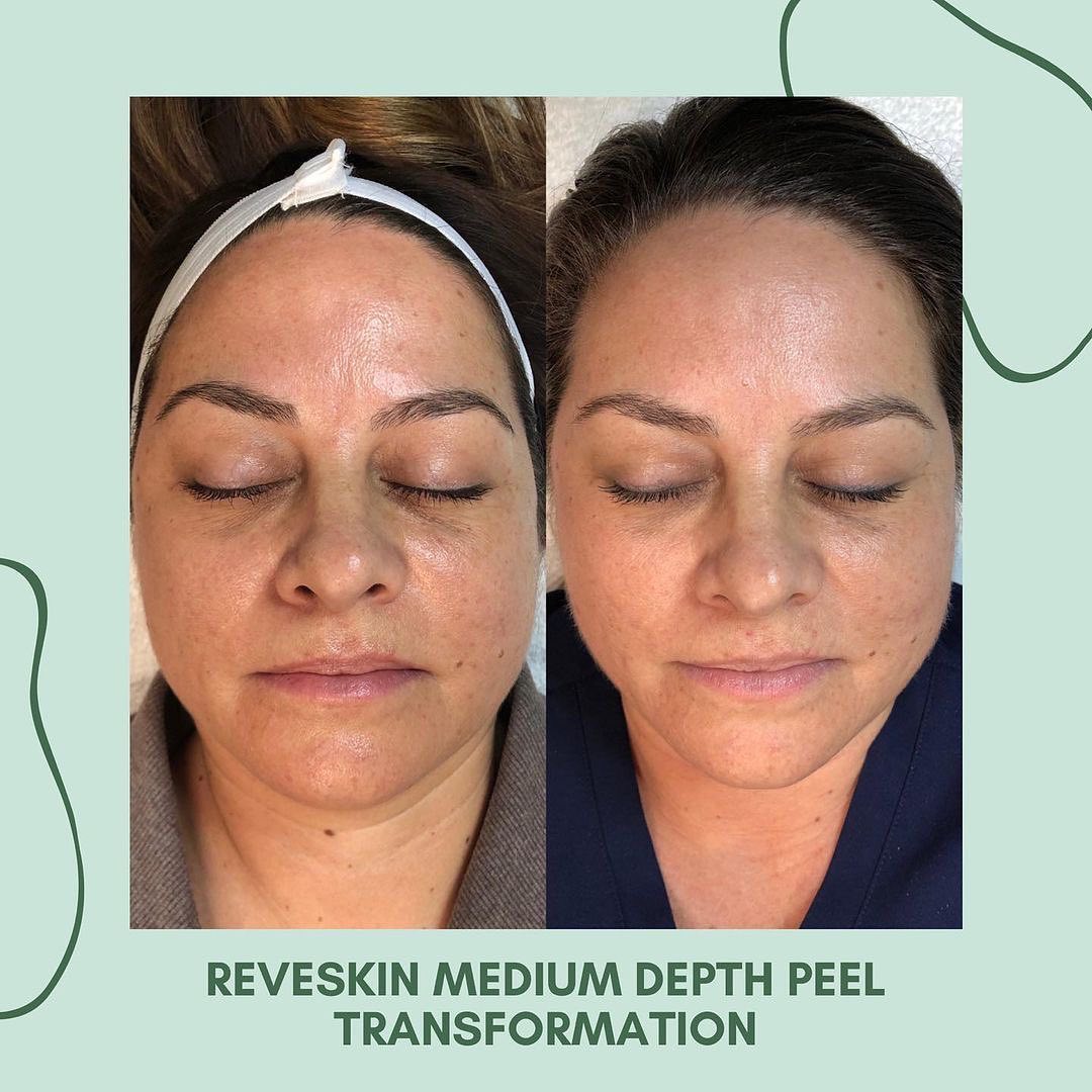 myderm glutathione with micro peel tech RevePeel ReveSkin Pre and Post Treatment. Amazing results. Thank you @bestskinjanetrn for believing in us and strictly following our protocol ✨ ✨ Posted @withregram • @bestskinjanetrn I'm obsessed with this glow Vitamin B12 Injection (Nature جلوتاثيوزوم سيروم Size:Full Size | 1.7 oz/50 ml
