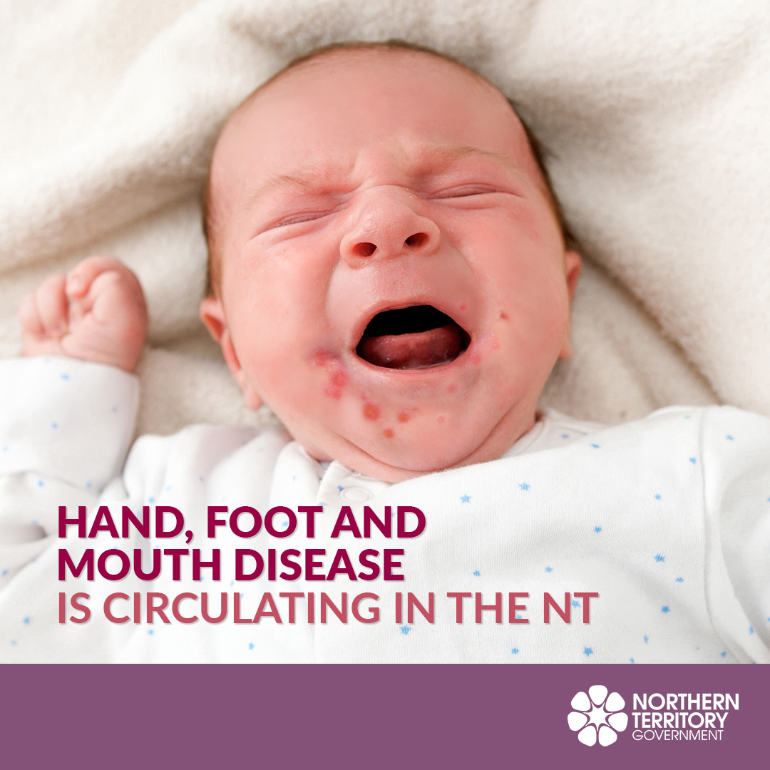 NT Health - ⚠️ Hand, foot and mouth disease is currently... | Facebook