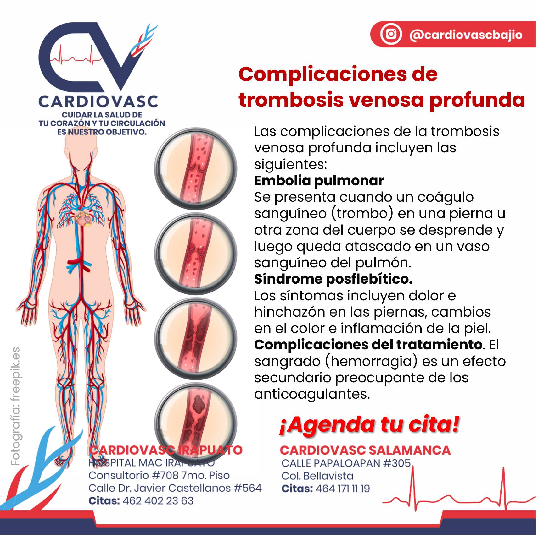 👉🏻COMPLICACIONES DE... - Cardiovasc Centro Cardiovascular | Facebook