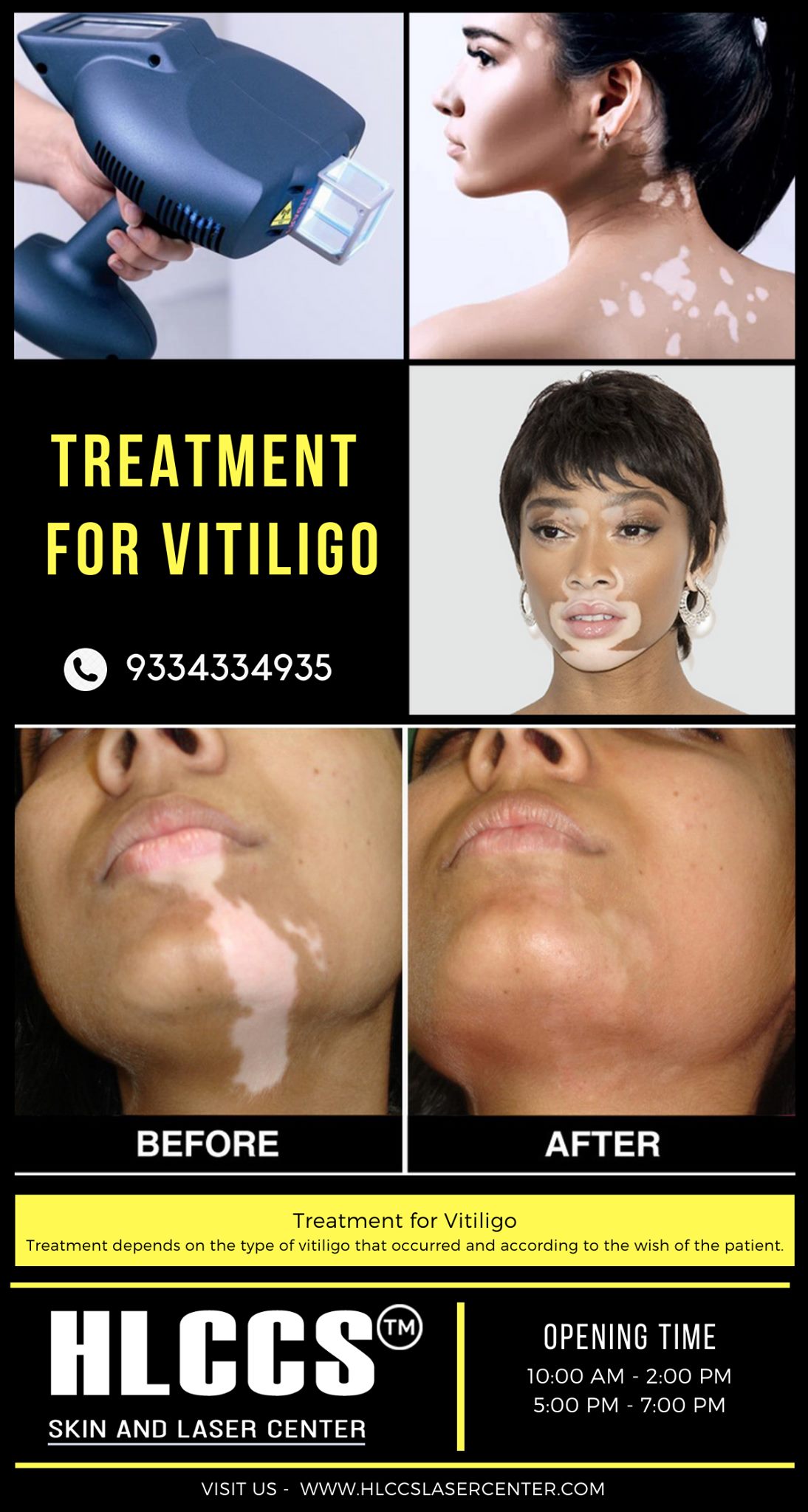 is glutathione safe for vitiligo What the best depigmentation option patients with ? A - Monobenzyl ether of Hydroquinone B - Hydroquinone C - Oral D glow drink