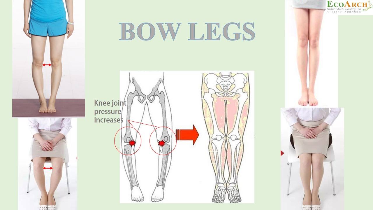 Eco Arch Malaysia - What is bow legs? Bow legs may be caused by ...
