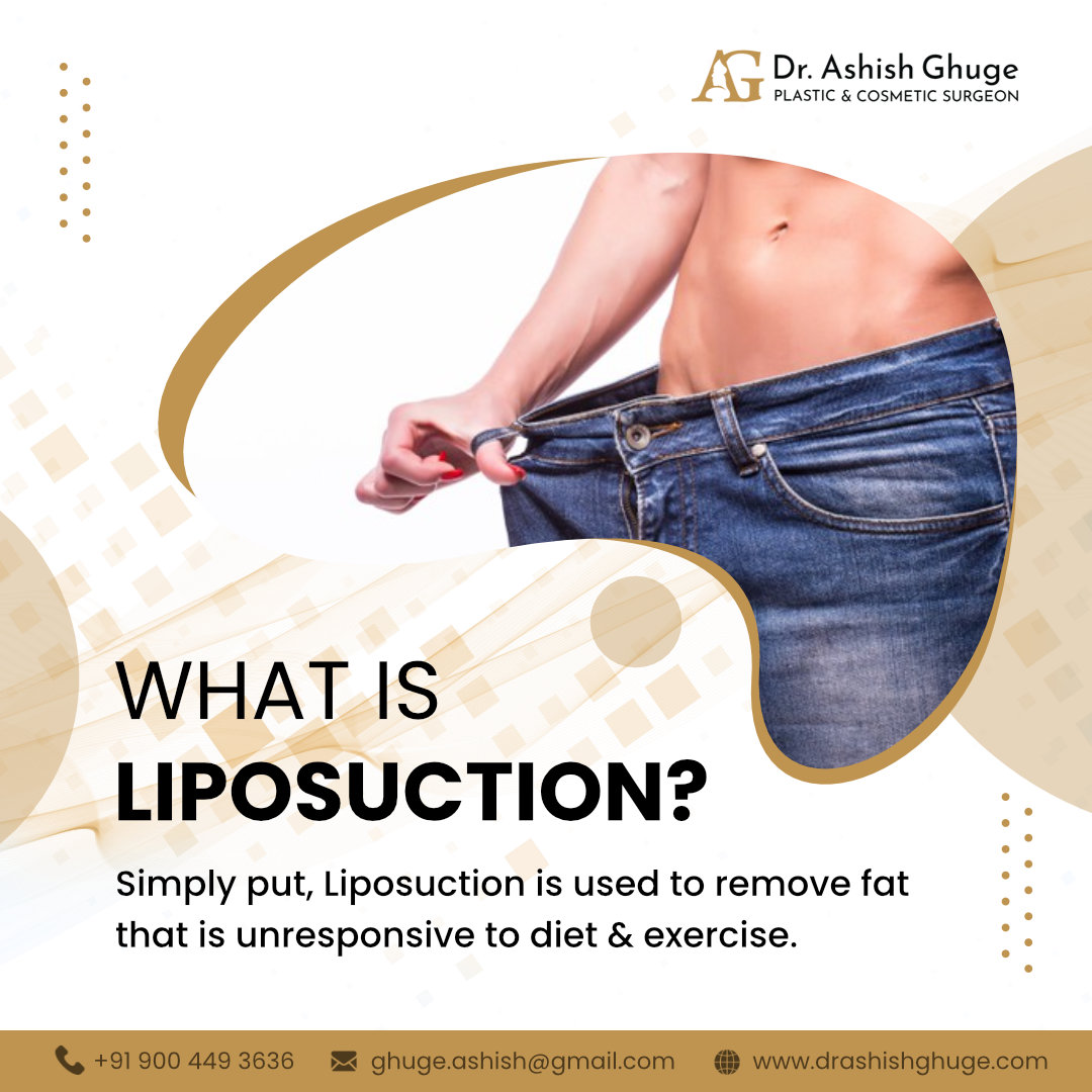 Liposuction is often misunderstood as a... - Dr. Ashish Ghuge | Facebook