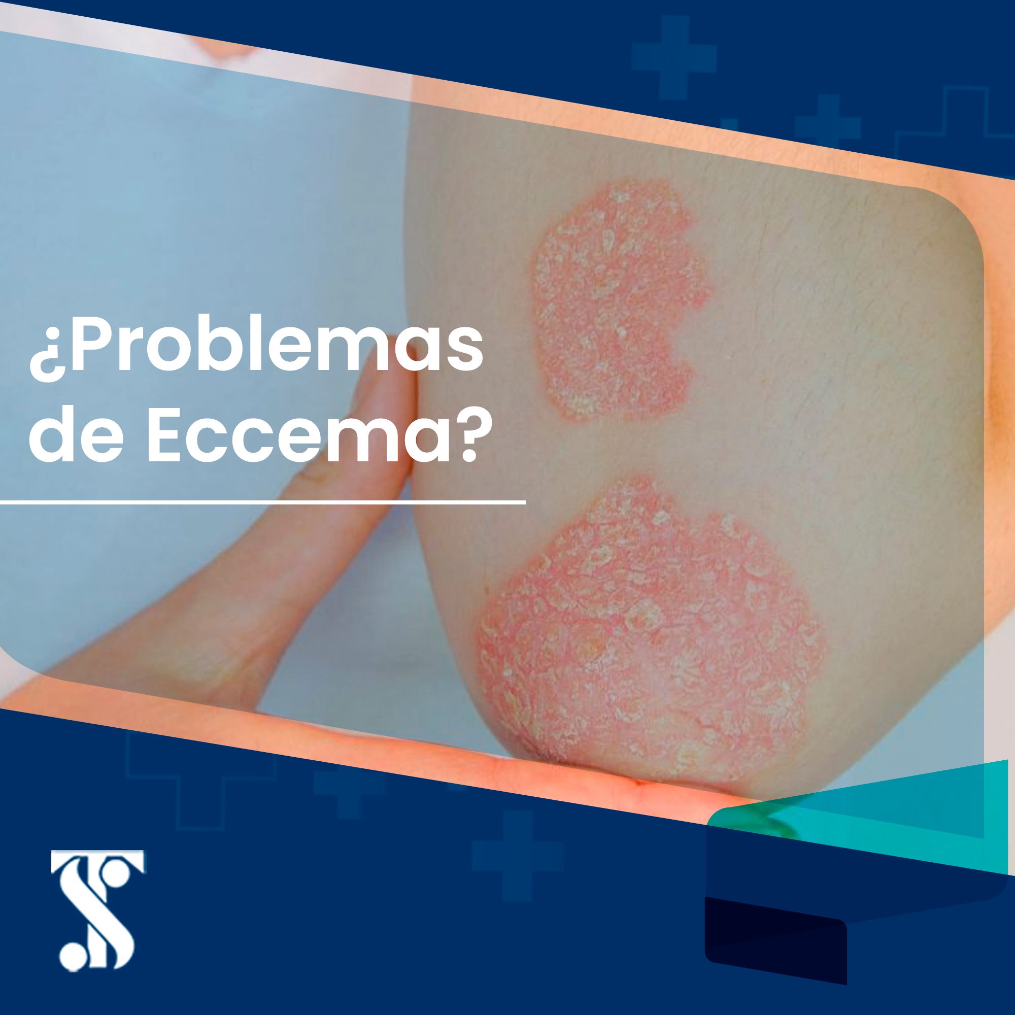 El eccema es una forma de... - Dr. Gerardo Sánchez Toledo