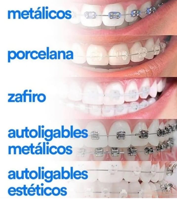 dental.care.ap - 🦷 NUESTROS TIPOS DE BRACKETS! 🟢 En...
