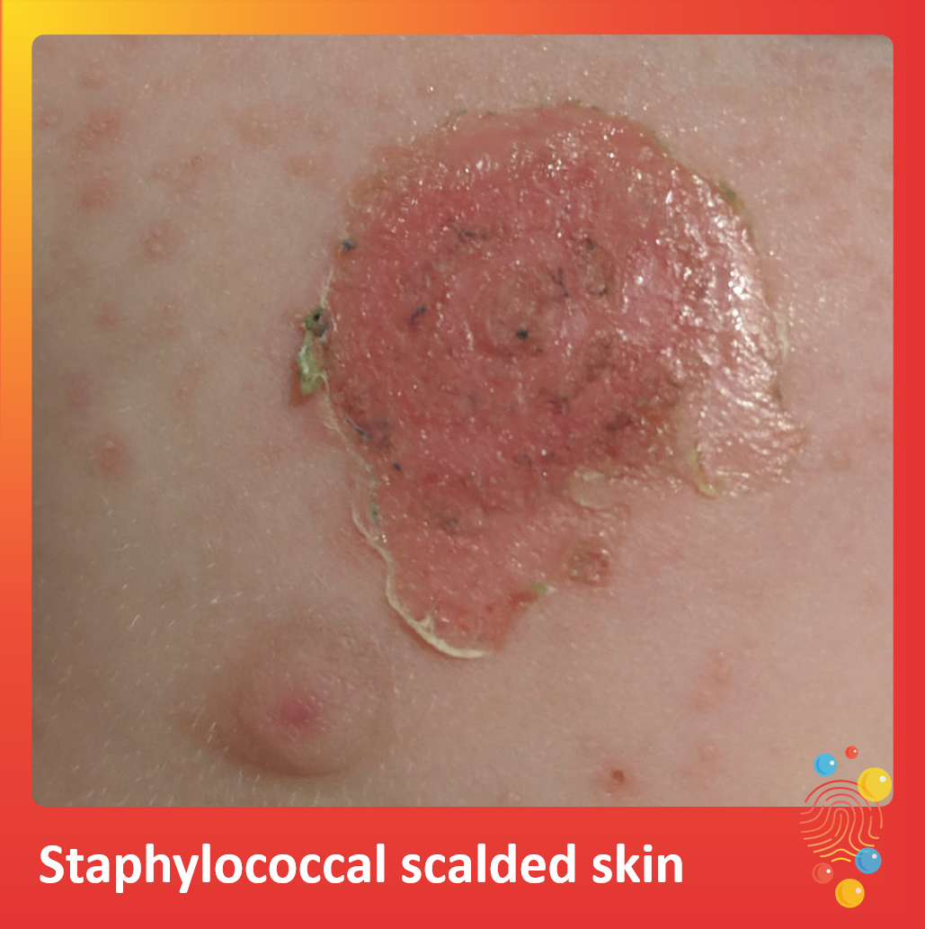 Staphylococcal scalded skin... - Don't Forget The Bubbles